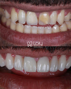 rehab oral y carrillas ceramicas